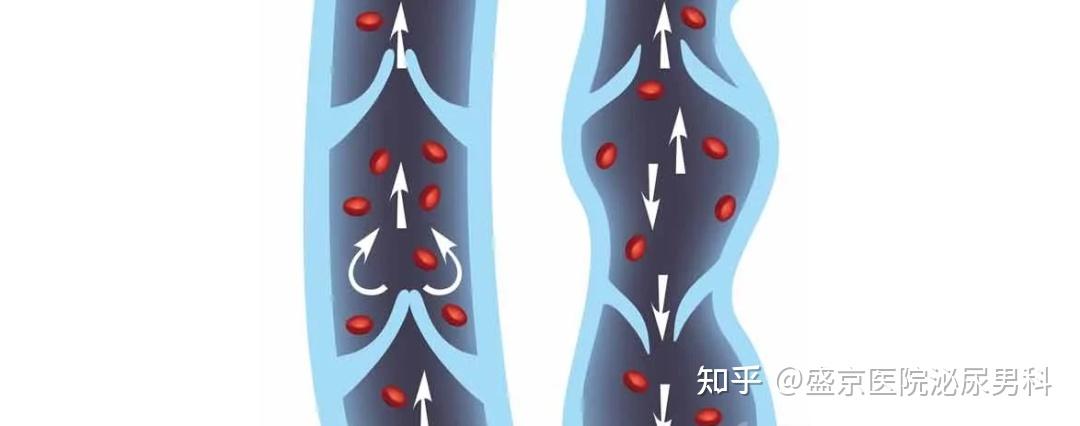 科普丨血管性 ED 分类大揭秘! - 知乎