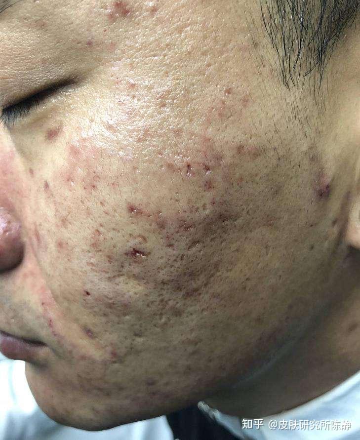 脸颊上的痘痘和痘印好几年都好不了激光祛痘可靠吗