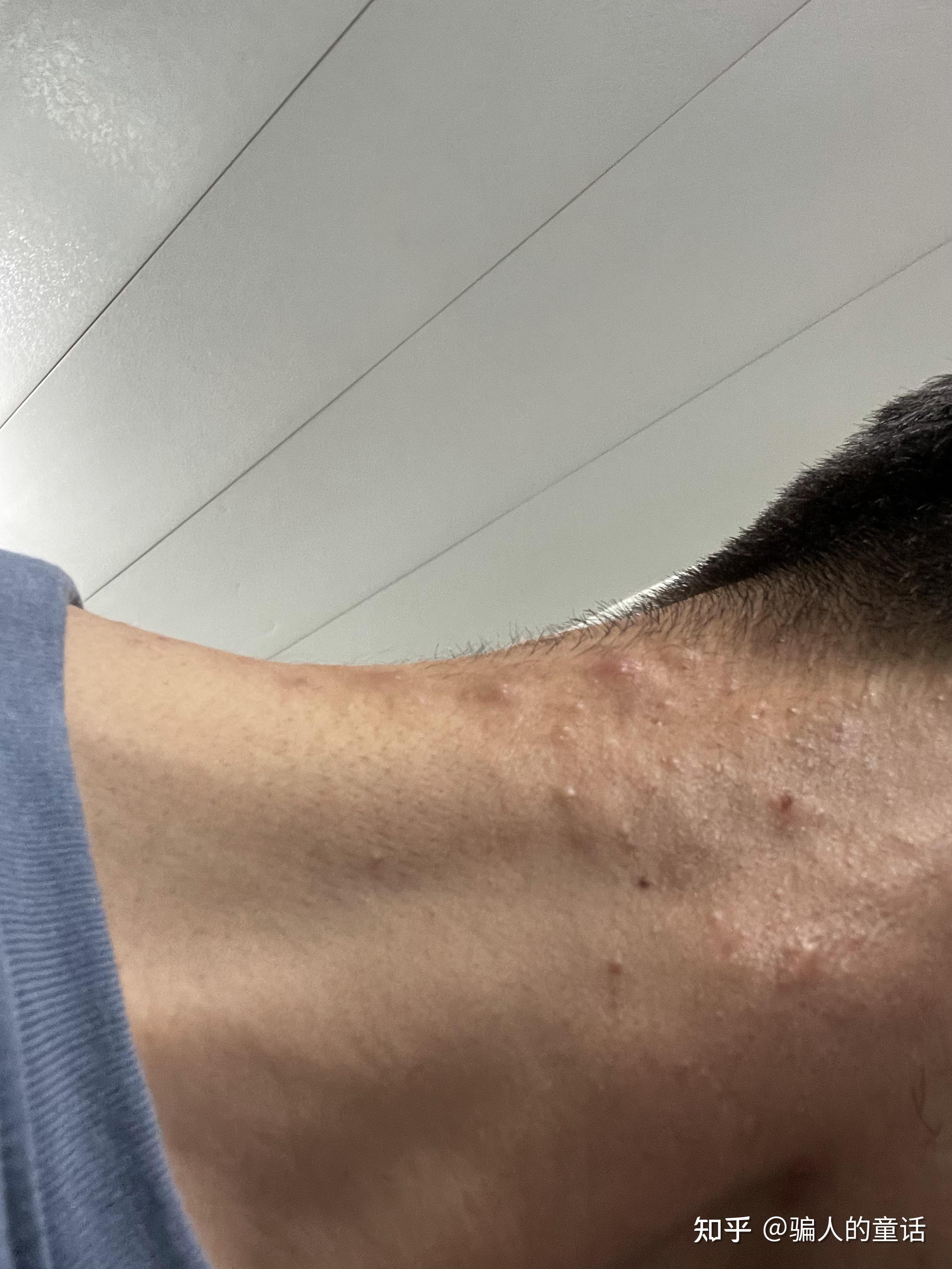 下巴和脖子交界处总长痘痘是什么原因该怎么办
