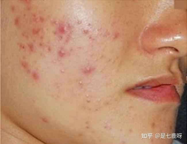 用水杨酸烂脸后该买什么祛痘印的产品