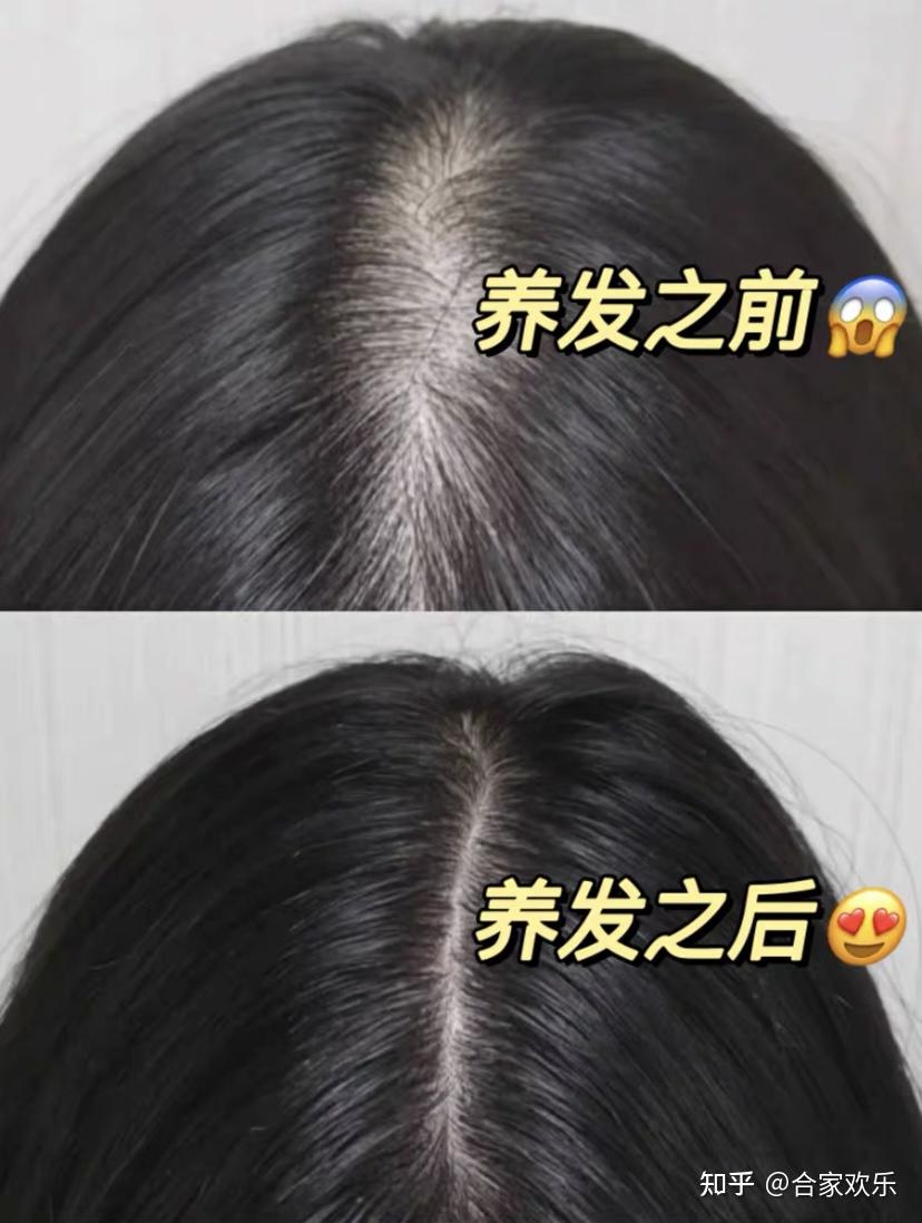 女生怎麼治療脂溢性脫髮 - 知乎