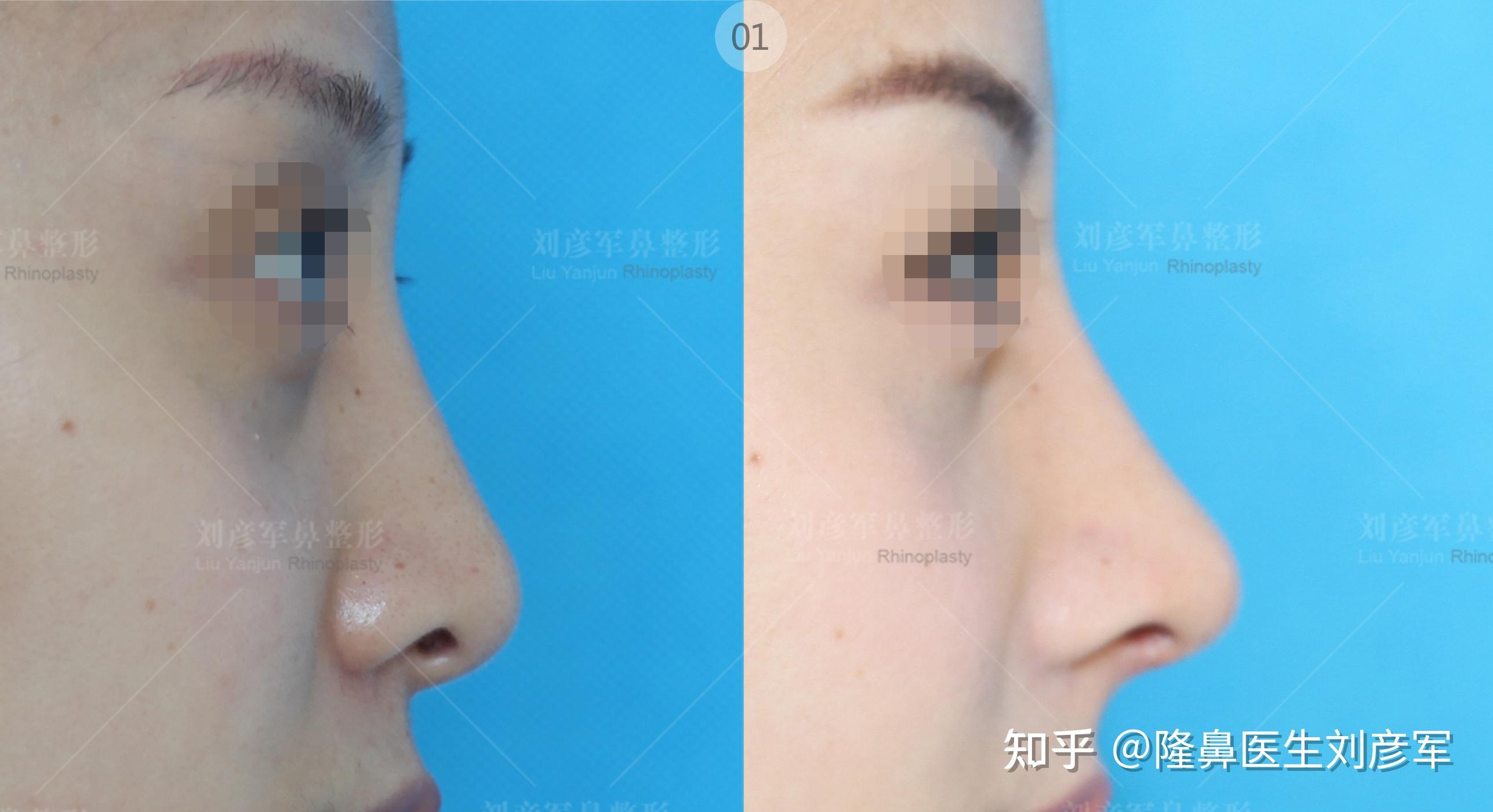 鼻子大鼻孔大鼻头肉怎么办? - 知乎
