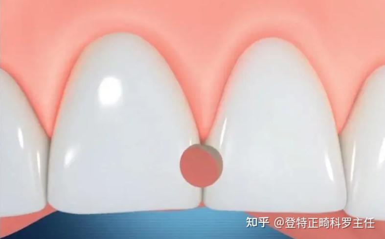 门牙牙缝大需要处理吗? - 知乎