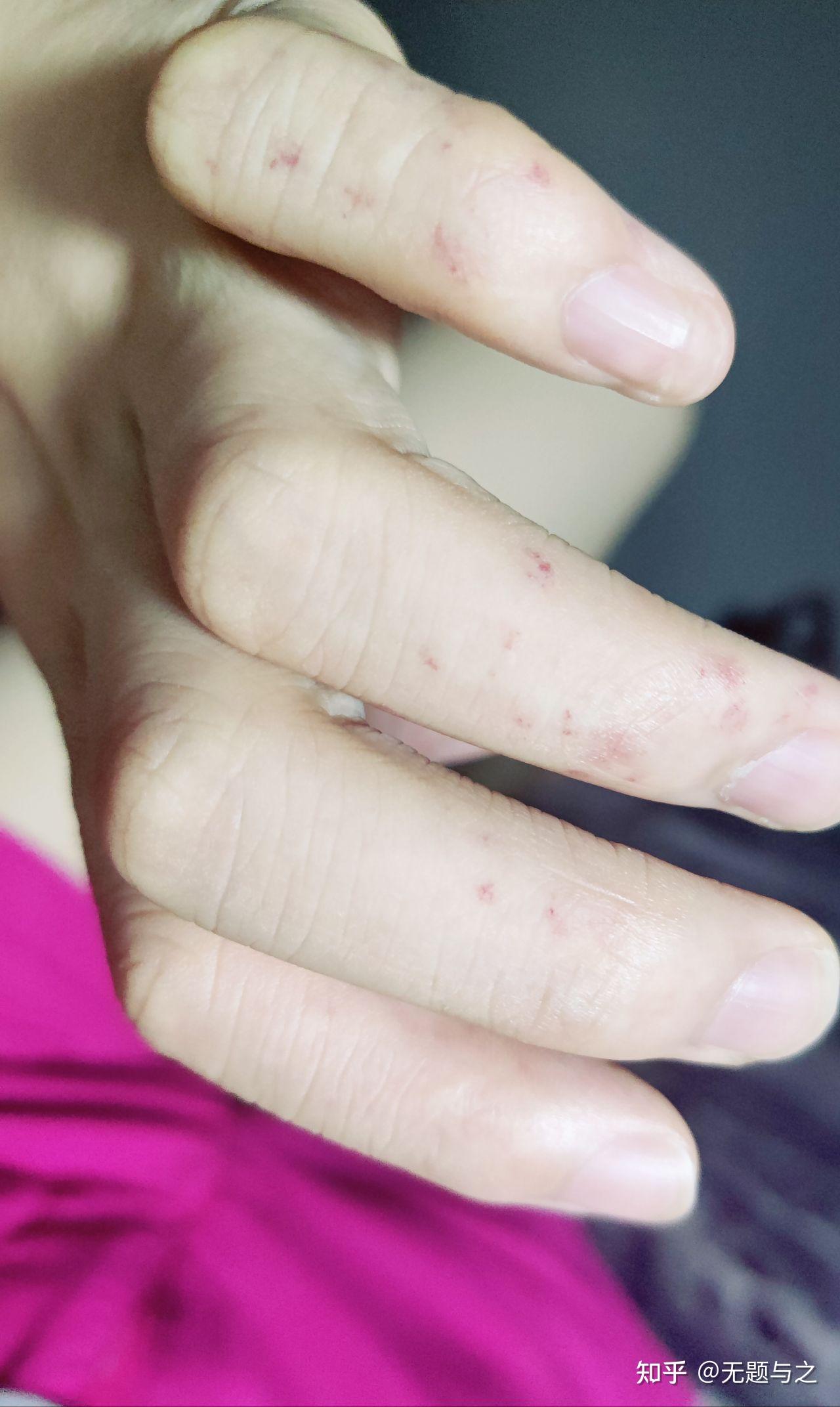 手指上长了一个针眼大的小红点 感觉像血管 一按就消失 松开就又出现