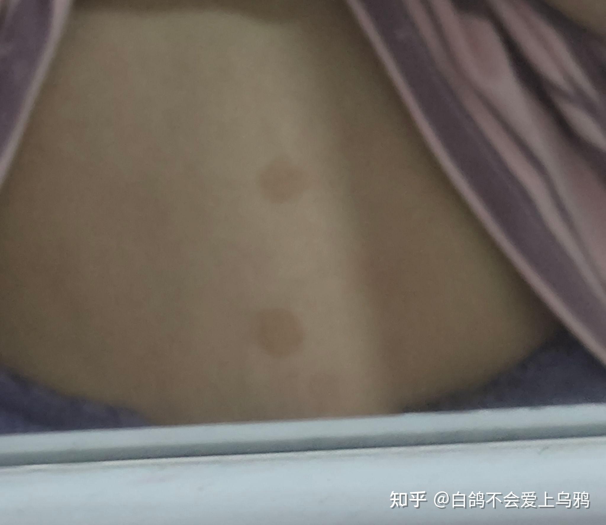 肚子上的棕色斑点是什么