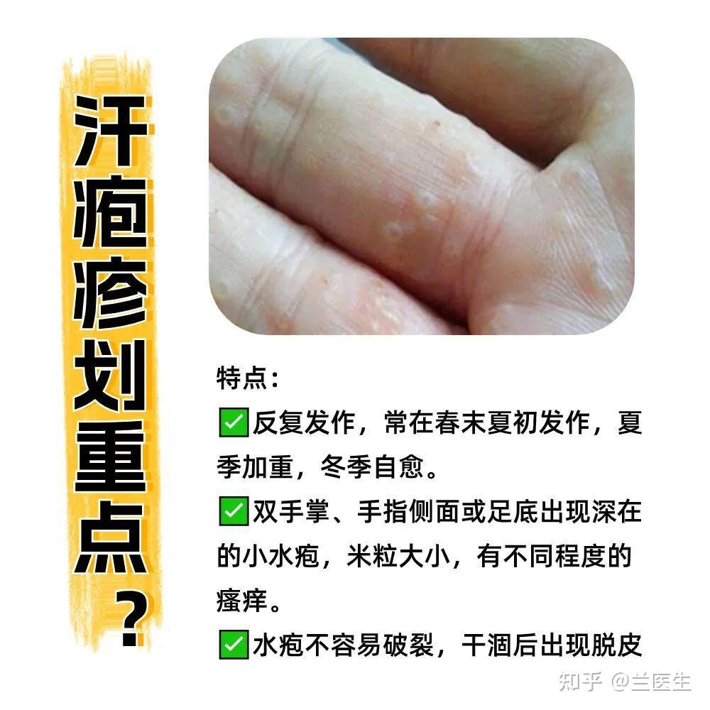 汗疱疹最简单的自愈方法? - 知乎