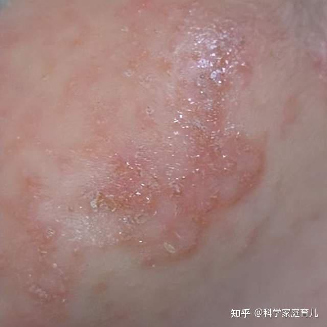 潮湿闷热,宝宝又起痱子?预防+缓解,记住6个字,现在就做! - 知乎