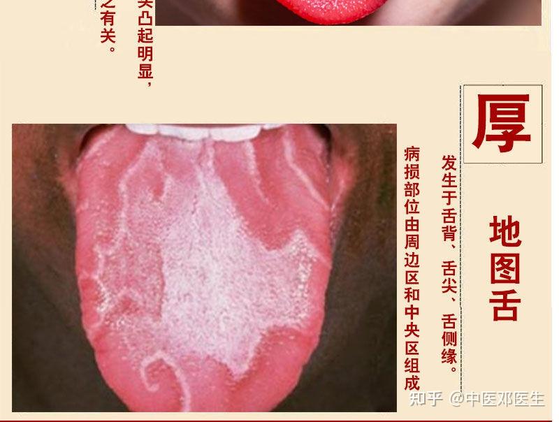 地图舌可以从脾胃入手 - 知乎