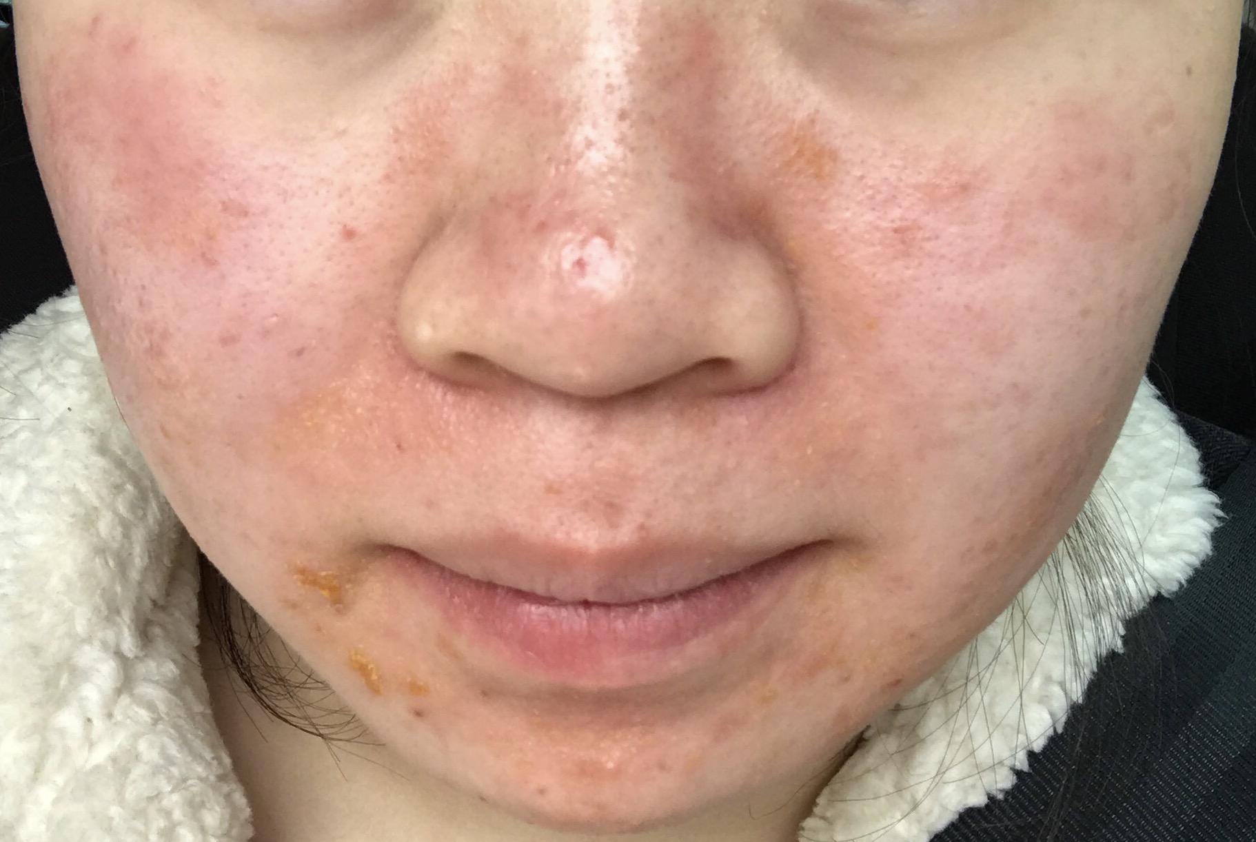 脸部过敏的问题如何解决