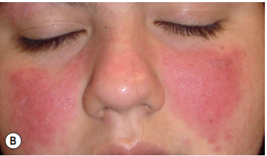 10个红斑狼疮早期症状征兆长什么样皮肤真实图片