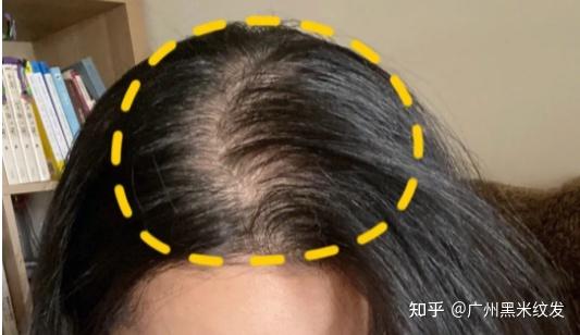 黑米SFP纹发:女性发缝过宽可以纹发吗？ - 知乎