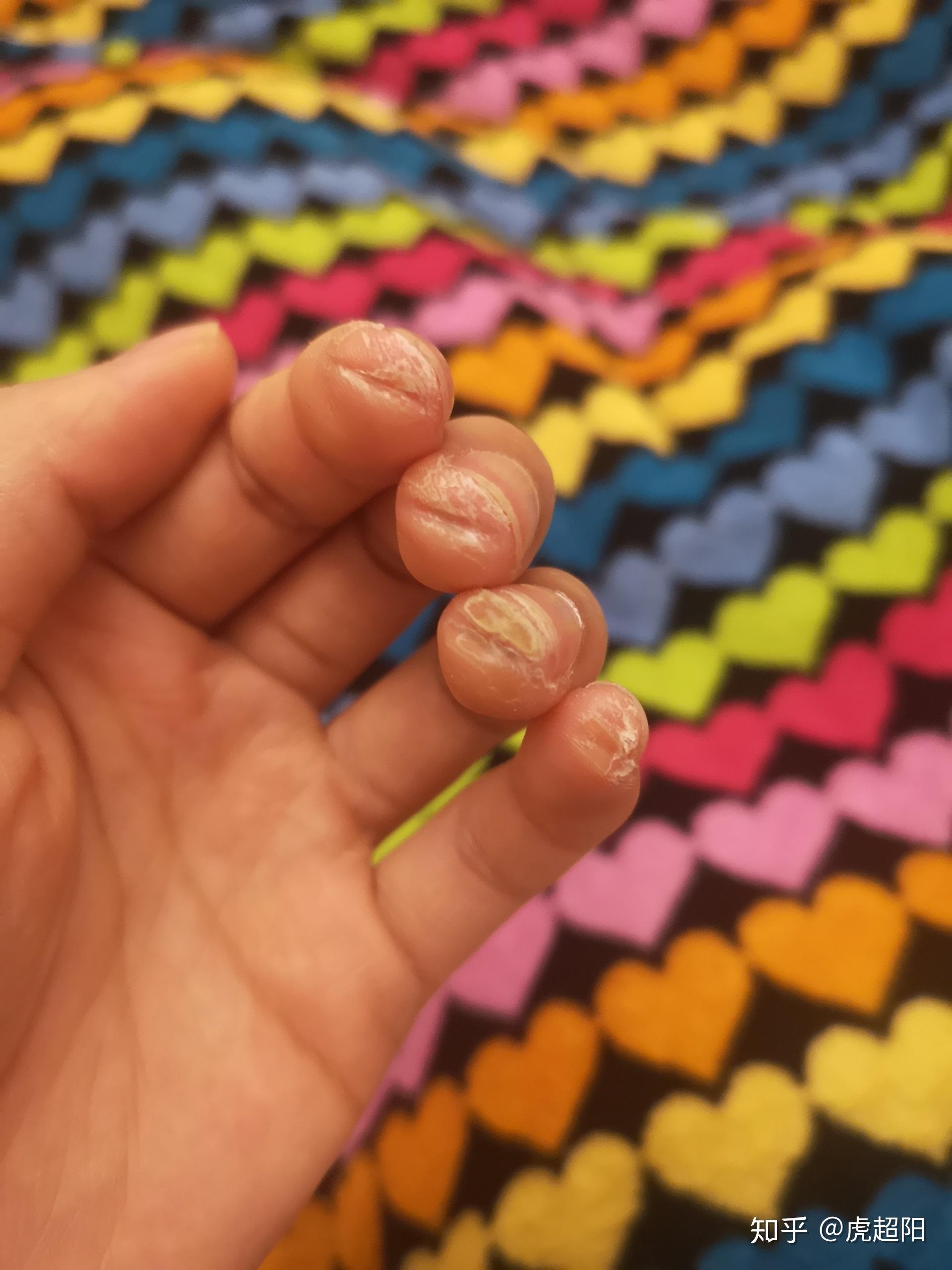 你弹吉他的手指已经变成什么样了?