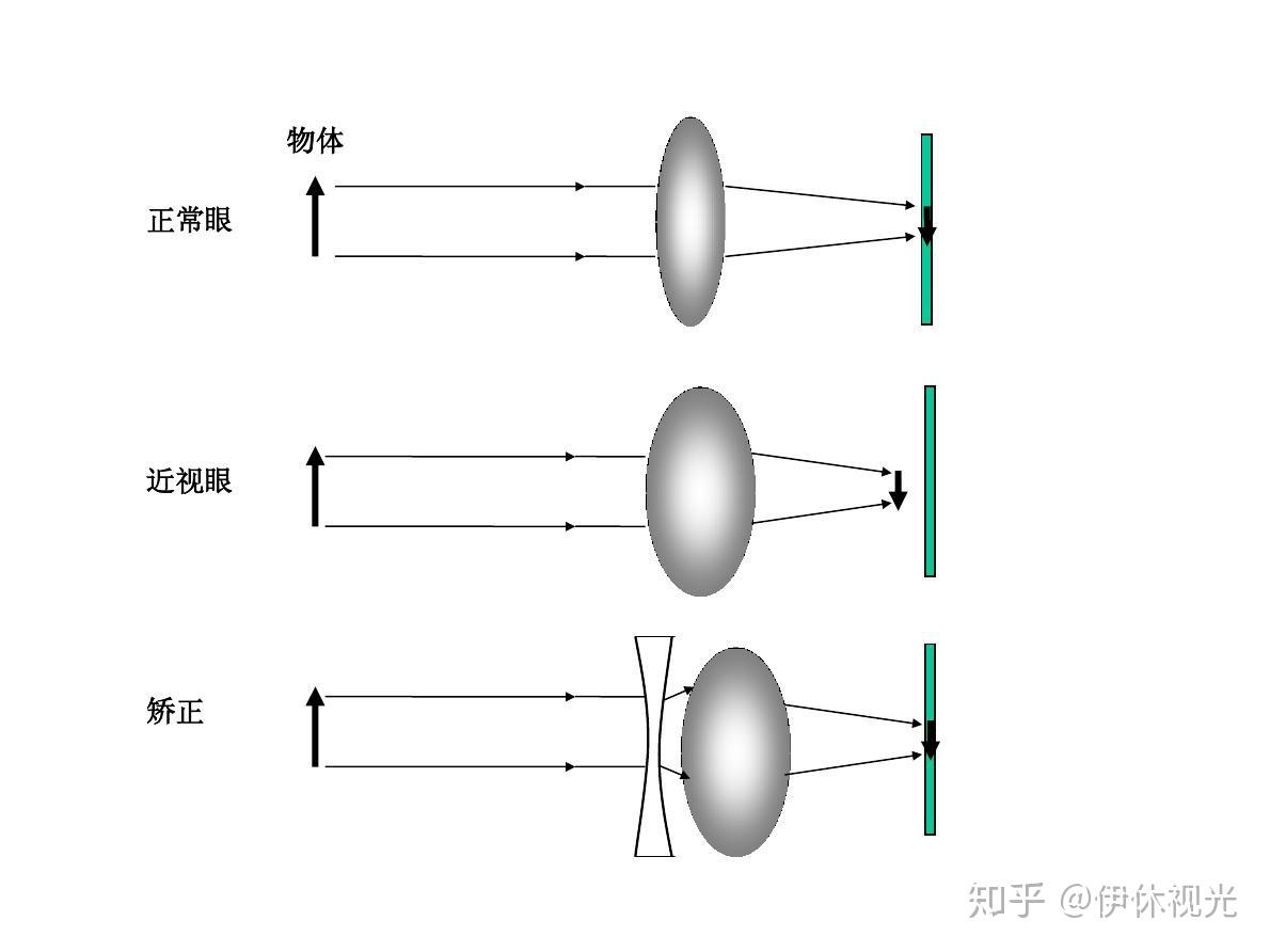 防蓝光近视镜有必要吗是收智商税吗