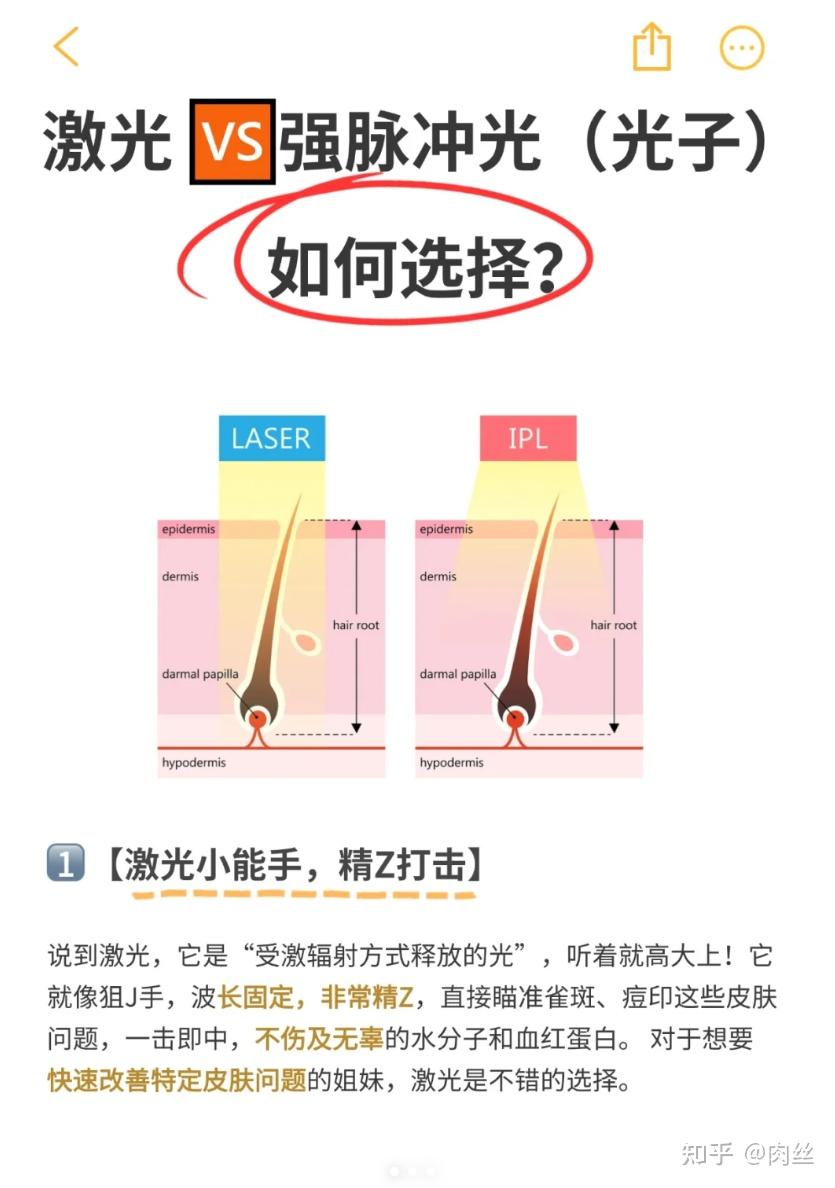 激光VS强脉冲光,选择困难症必看 - 知乎