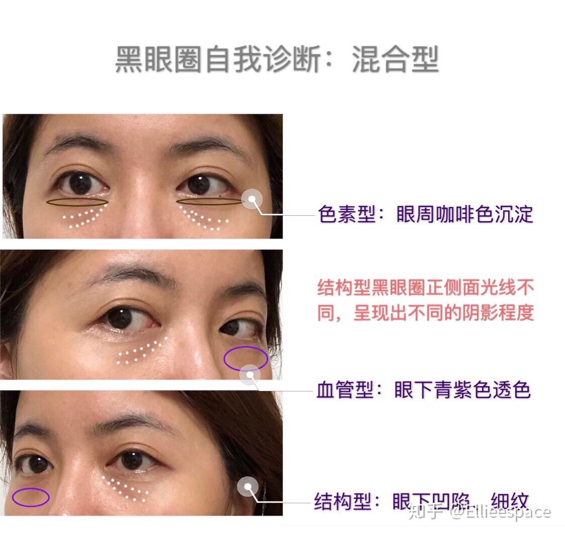 怎么判断黑眼圈的种类怎么消除