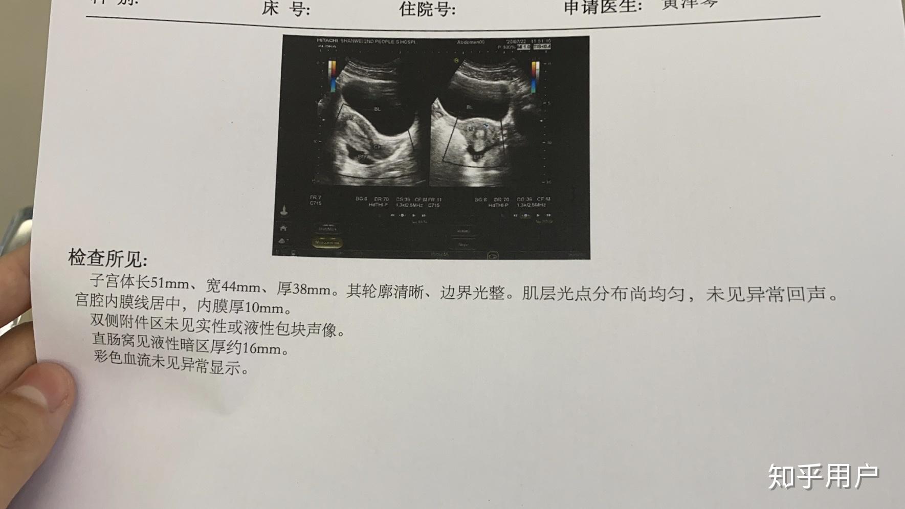 黄体破裂是一种什么体验? - 知乎