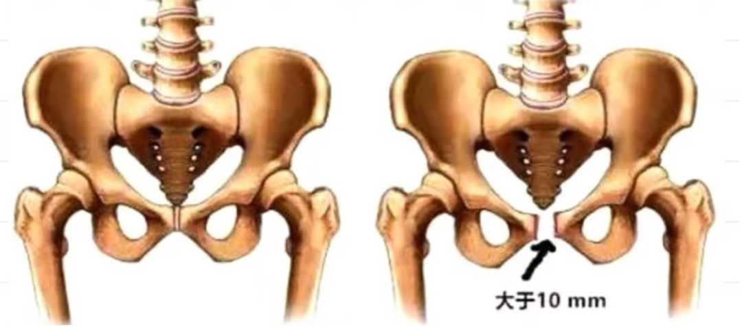 【康复分享】产后康复——耻骨联合分离的治疗 - 知乎