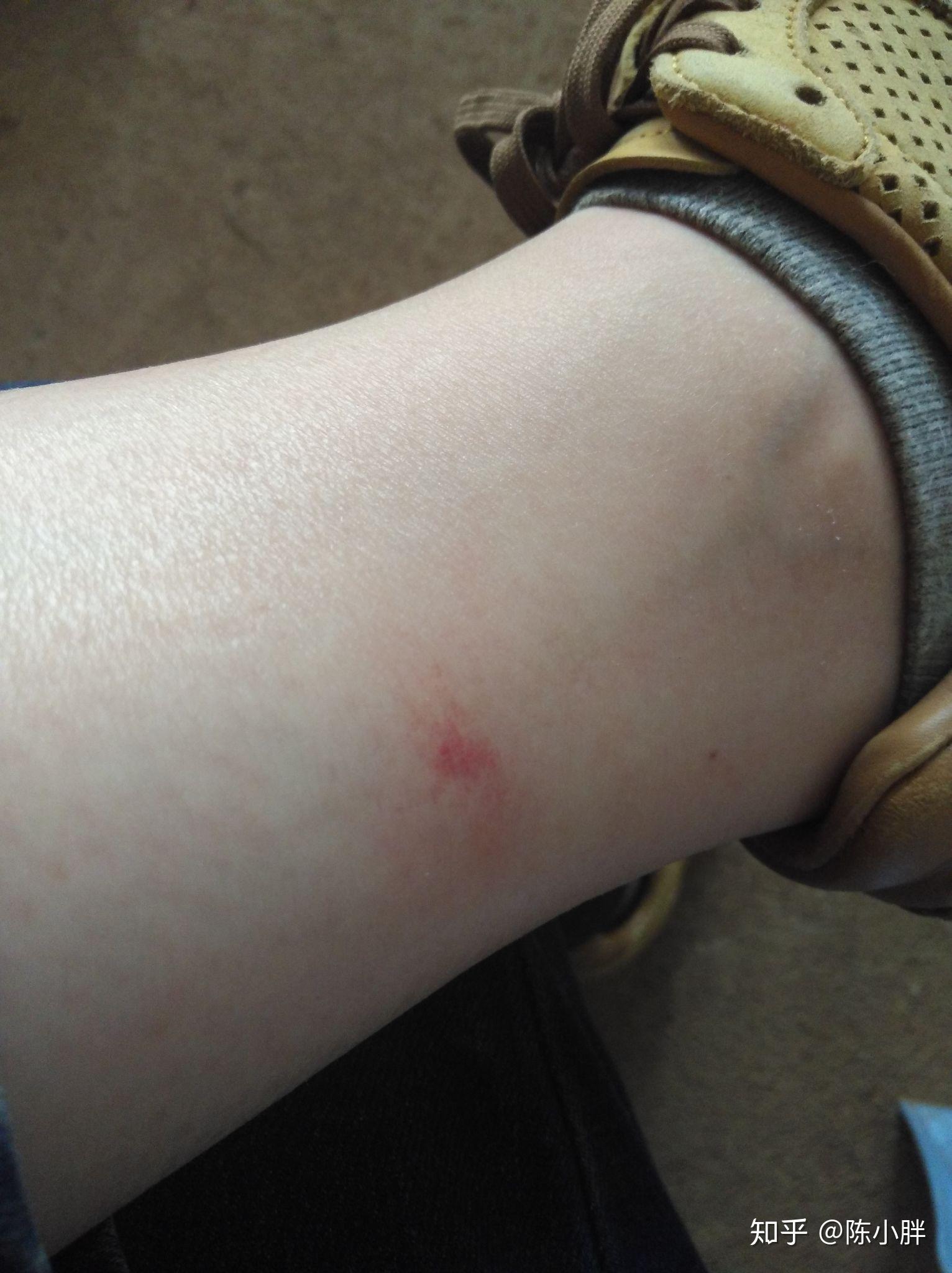 被小咬(一种黑色小飞虫)咬了痛痒难当,怎么破?