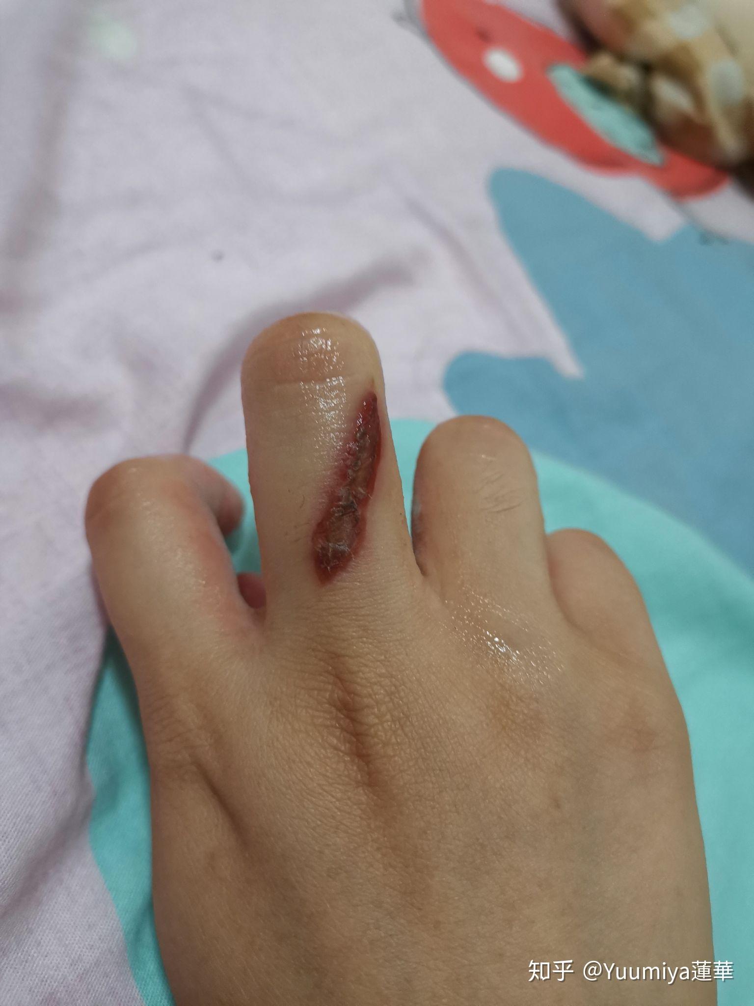 被电烙铁烫伤是一种什么样的体验?怎么处理不易留疤?