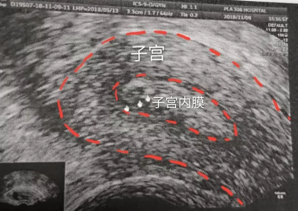 教你看懂妇科B超报告!超级干货来啦! - 知乎