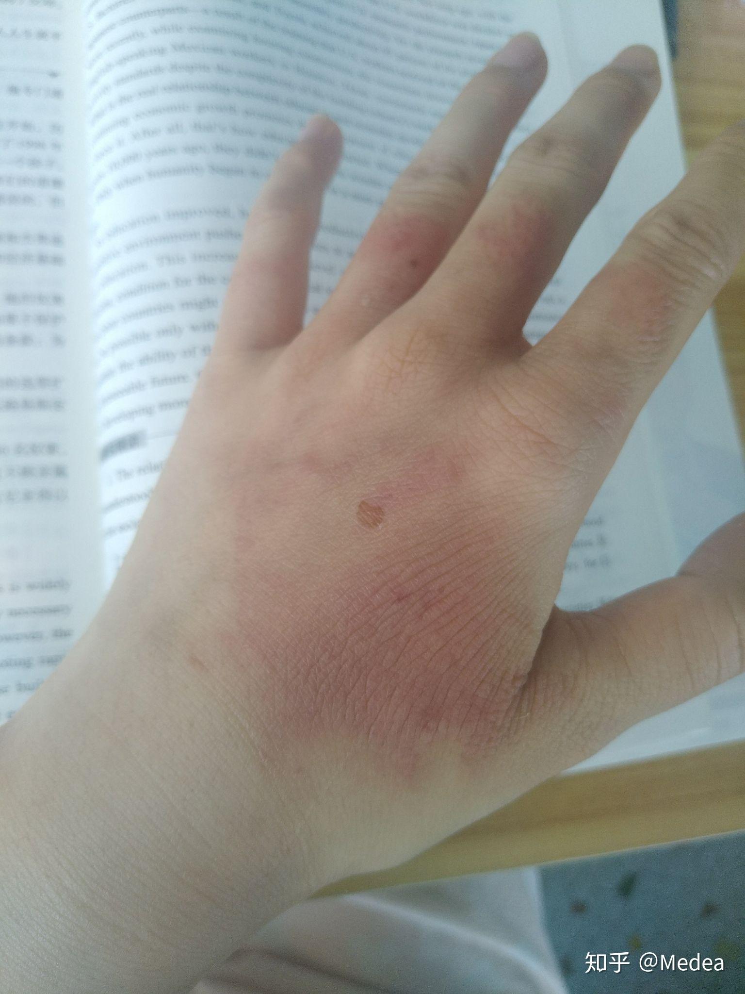 手被开水烫伤了怎么办? - 知乎