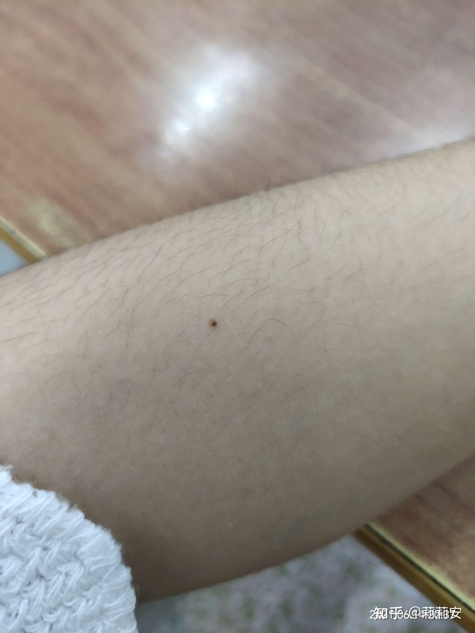 苍蝇(蚊子)屎真的会长在脸上吗? - 知乎