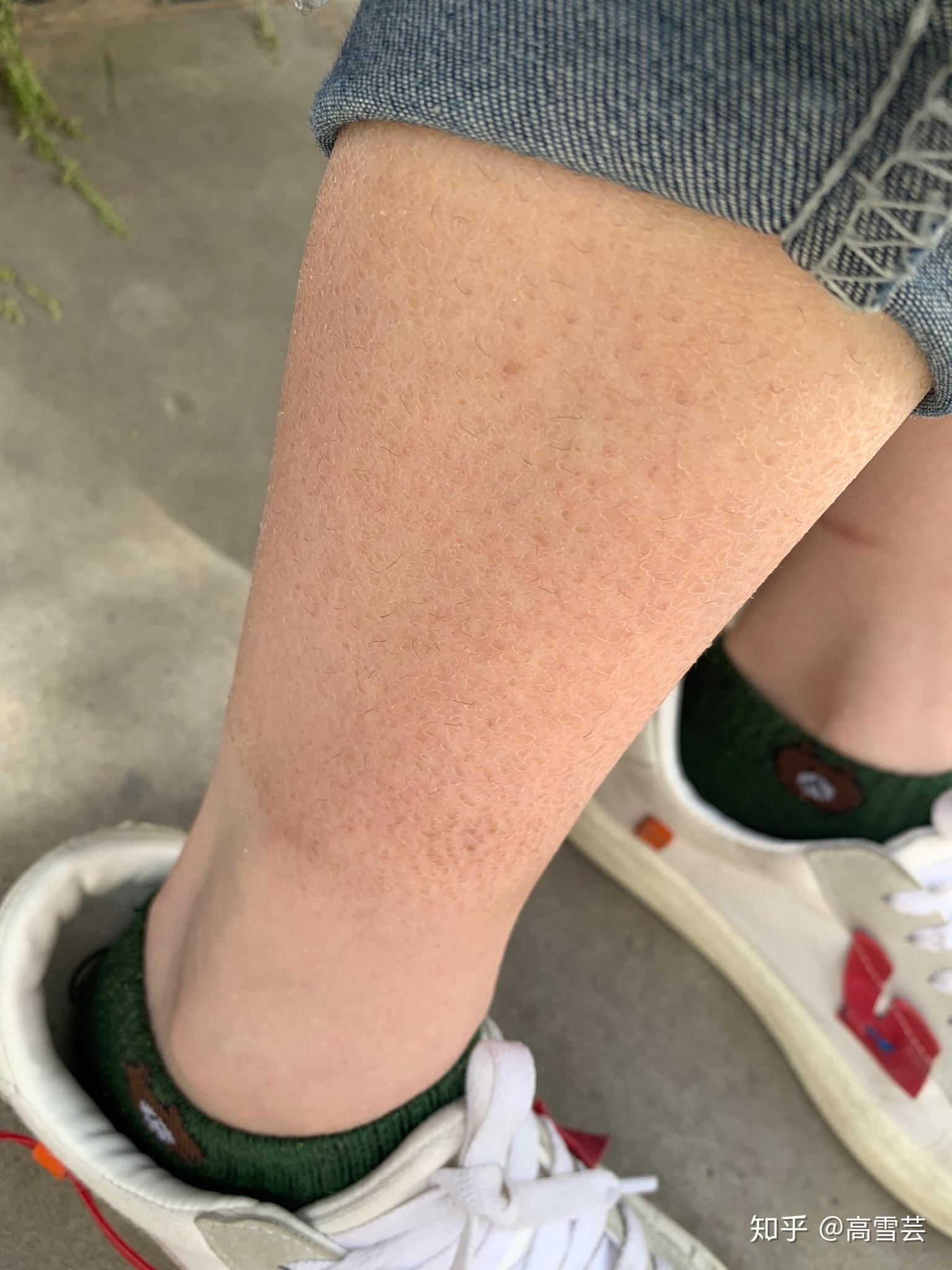 谁能帮我看下我的腿部皮肤咋回事小腿不疼不痒就是看着恶心