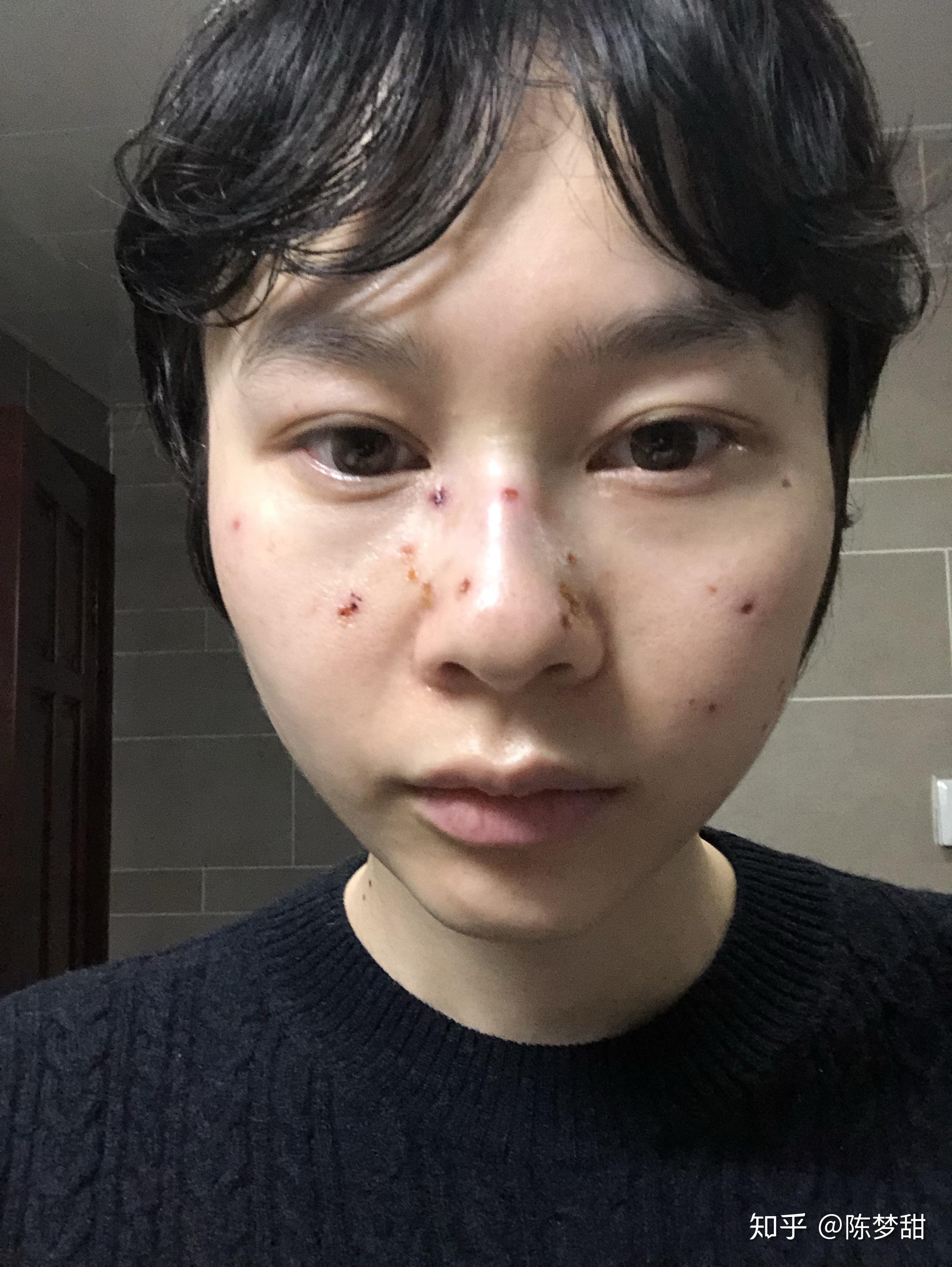 激光點痣和藥水點痣那個比較安全