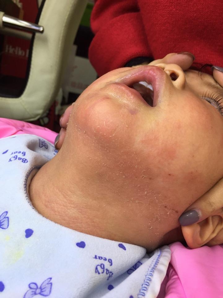 我小孩属于严重过敏体质对大豆和蛋白质高度过敏对尘螨也过敏最近脖子