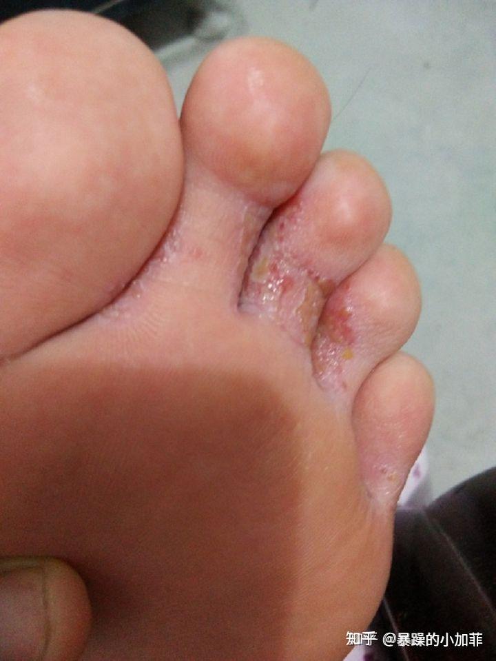 脚气是如何免费治好的