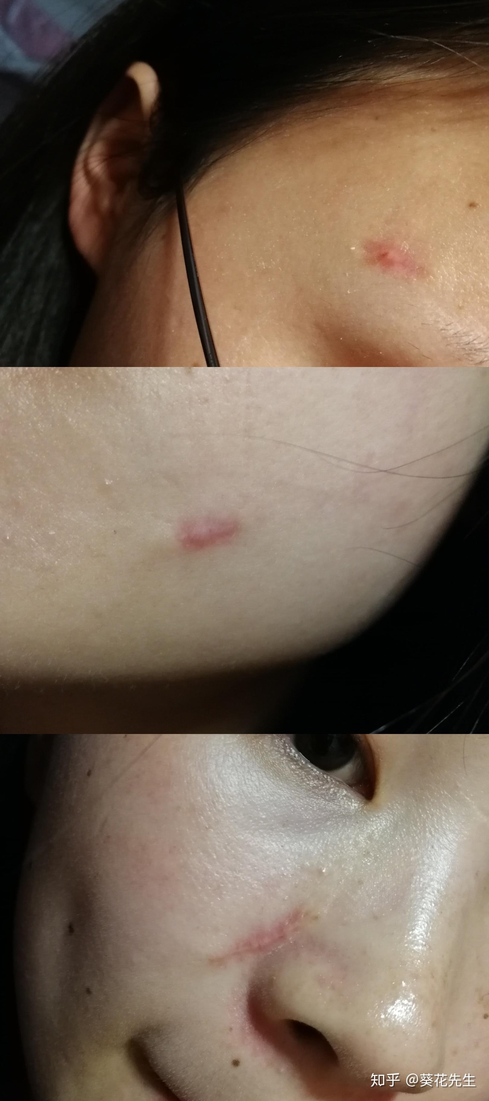 手术切痣是一种怎样的体验? - 知乎