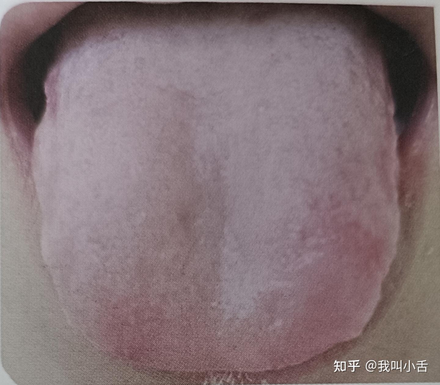 舌头的前世今生——望舌质——望舌形（胖大舌） - 知乎