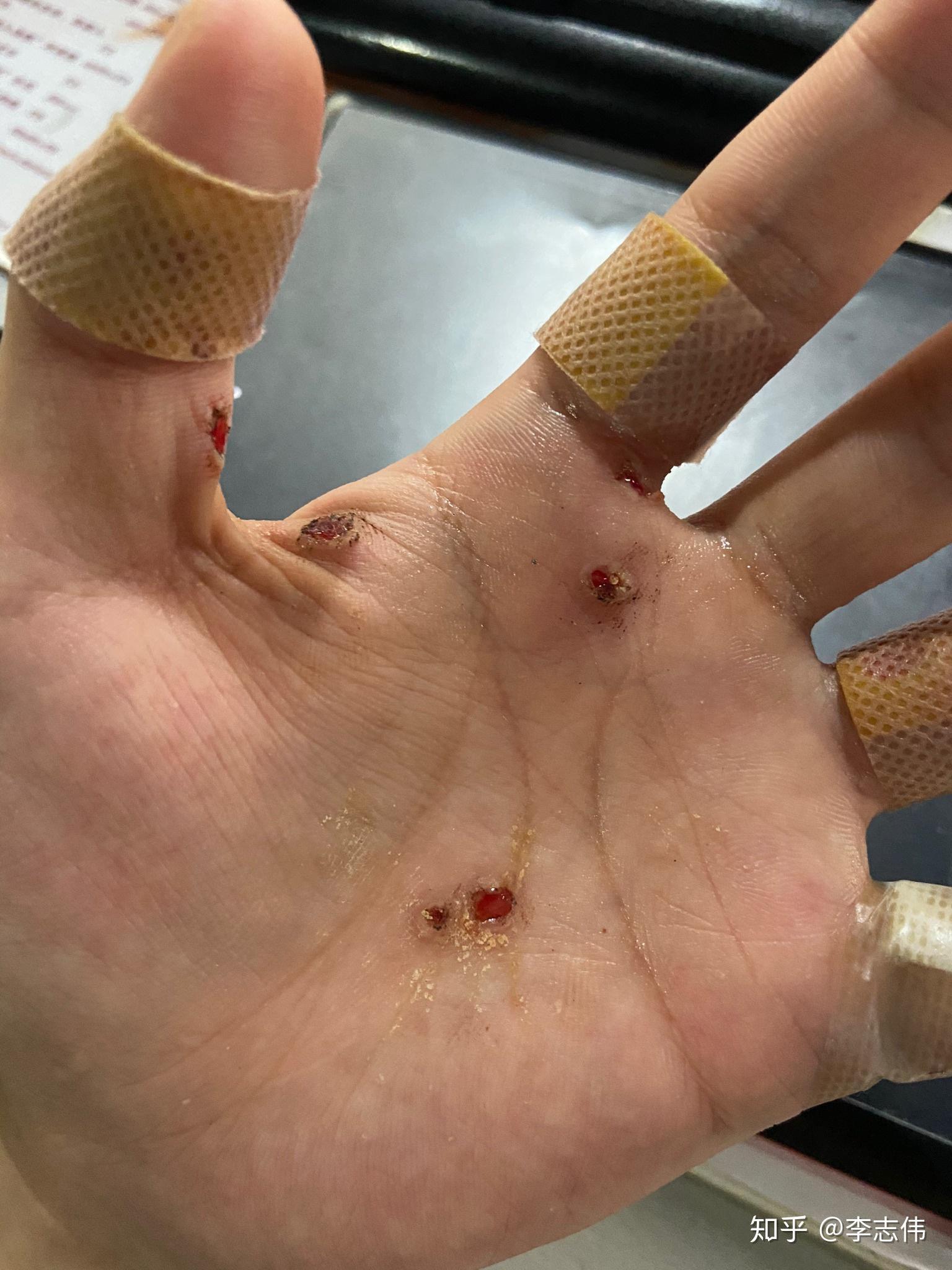 如何有效的治疗刺猴呢? - 知乎