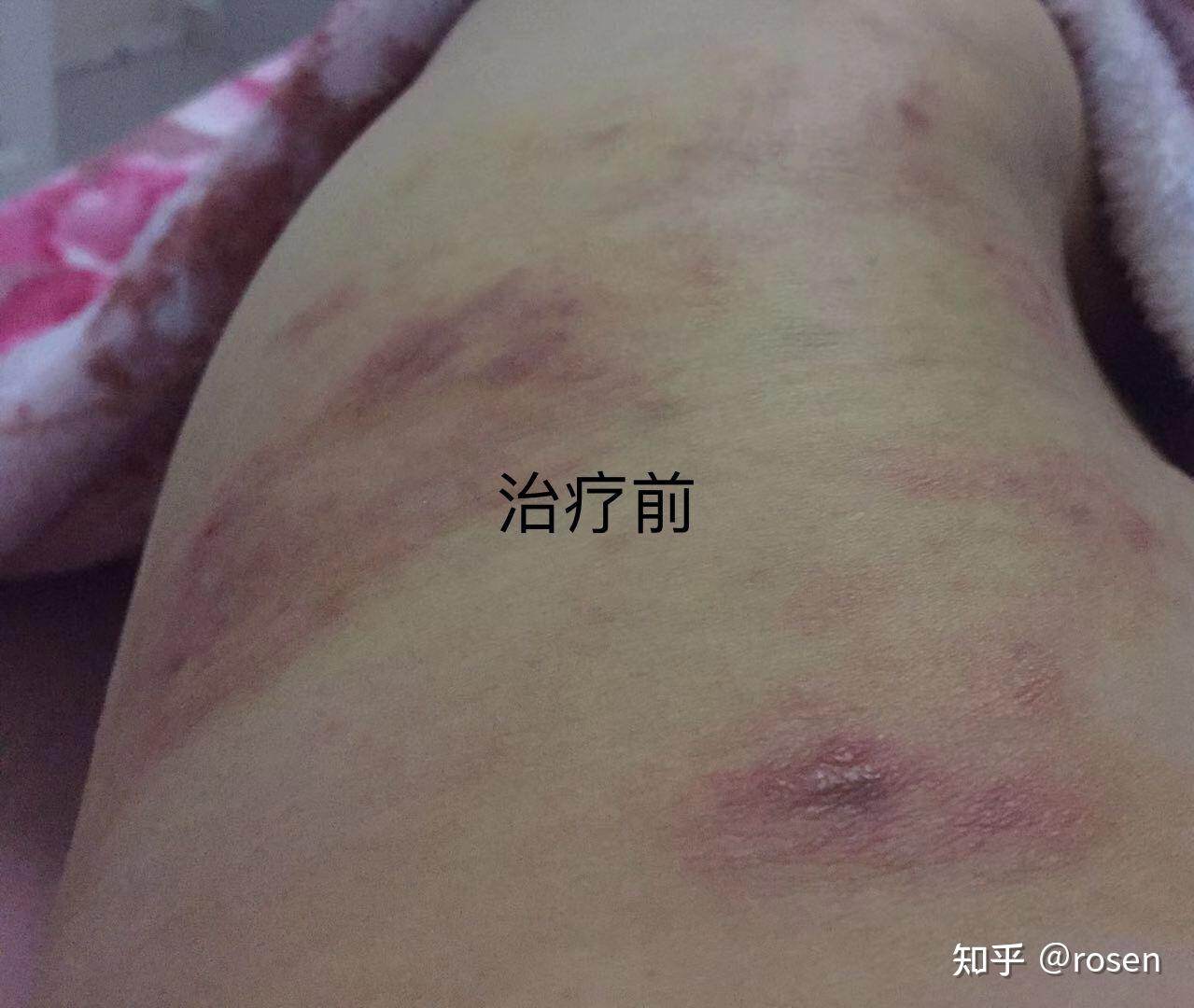 麻黄连翘赤小豆汤:治疗湿疹