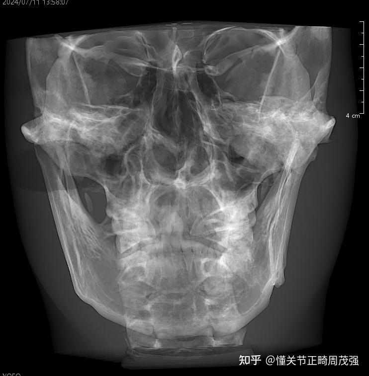 颞下颌关节紊乱与脊柱侧弯有关系吗? - 知乎