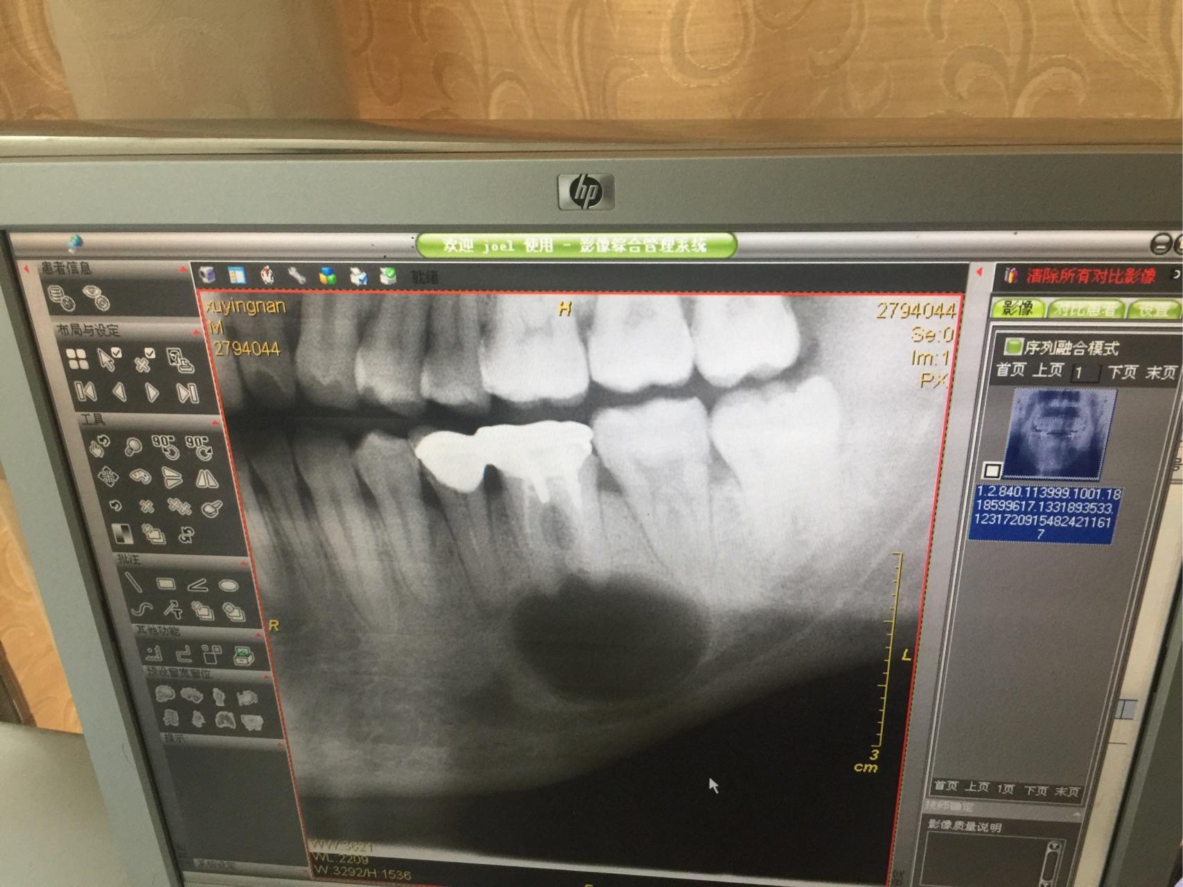 牙根尖囊肿术后一个星期后肿涨并每天中午过后同侧的头疼什么原因