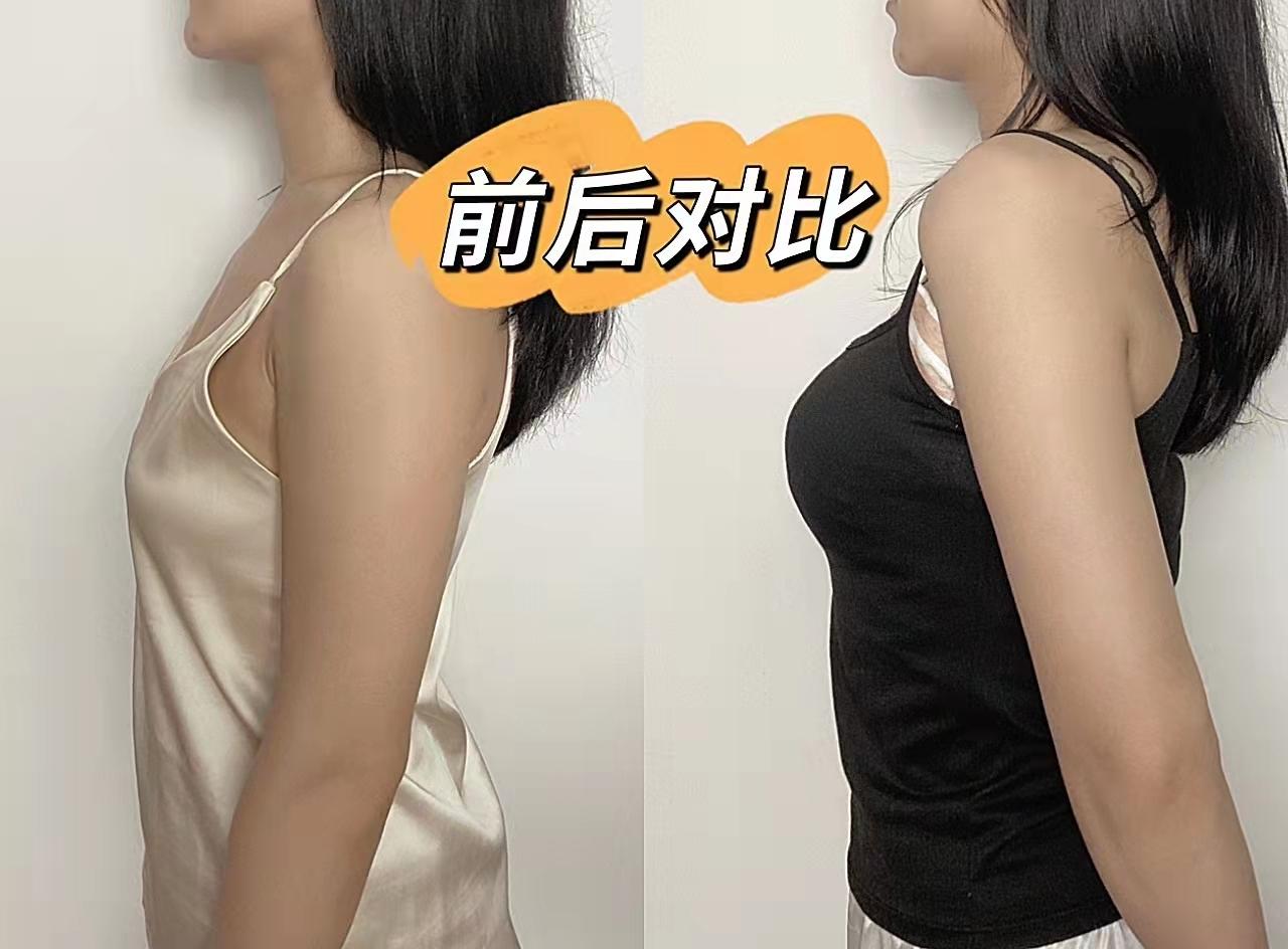 广州隆胸医生哪位技术更专业一点? - 知乎