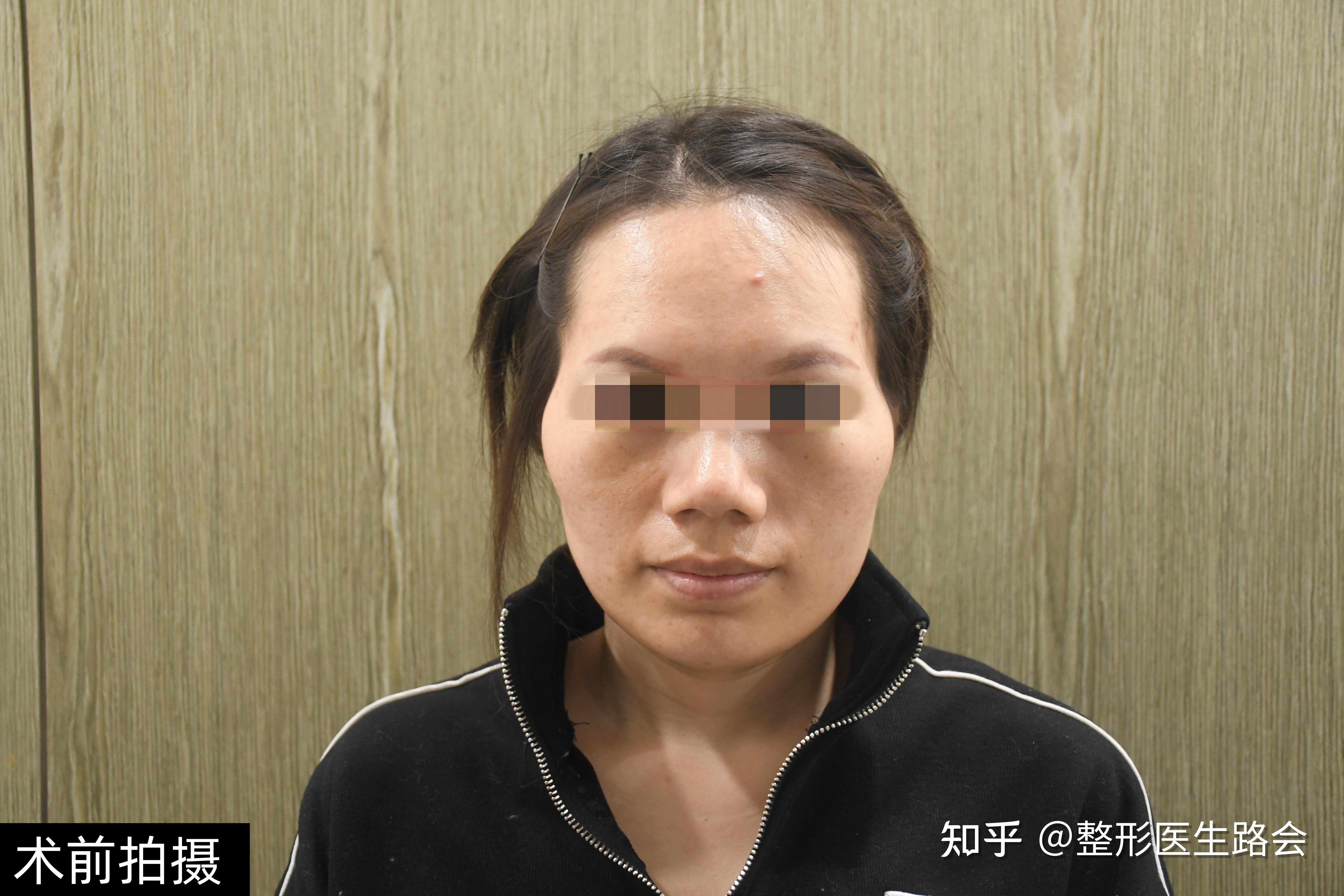 脸部凹凸不平该怎么解决