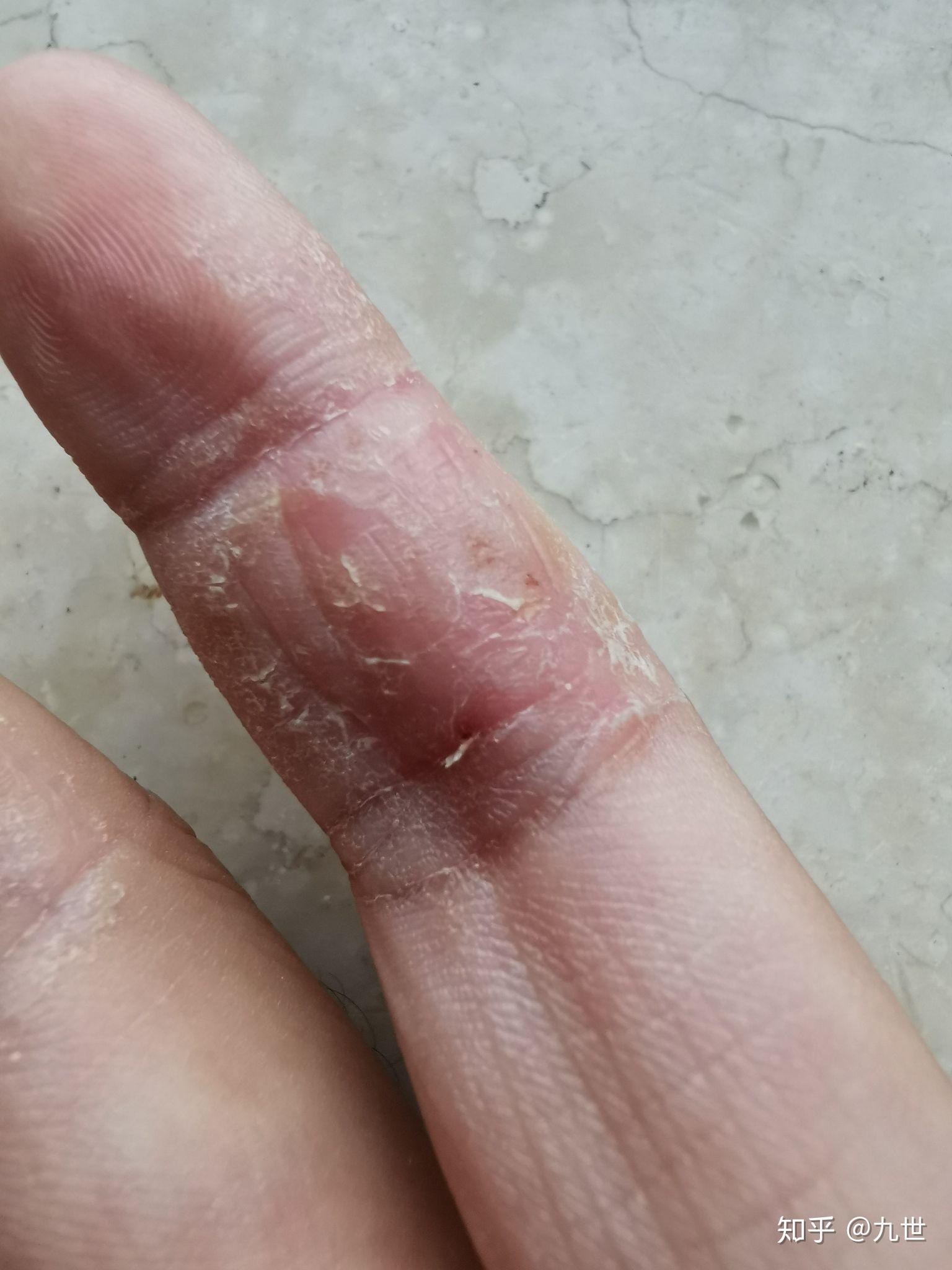 为什么手不容易被真菌感染? - 知乎