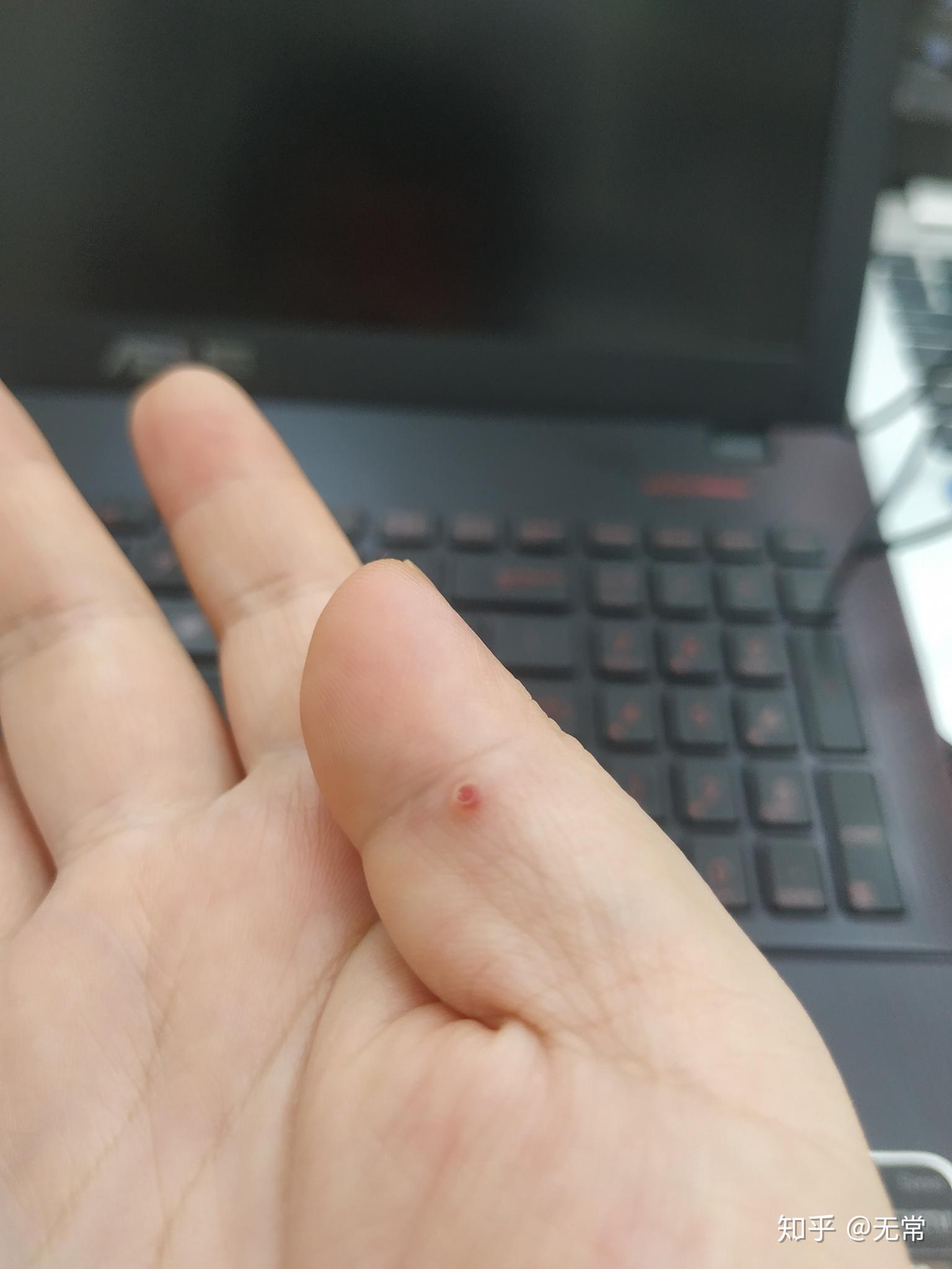 手掌长了个血泡,一直不好怎么办? - 知乎