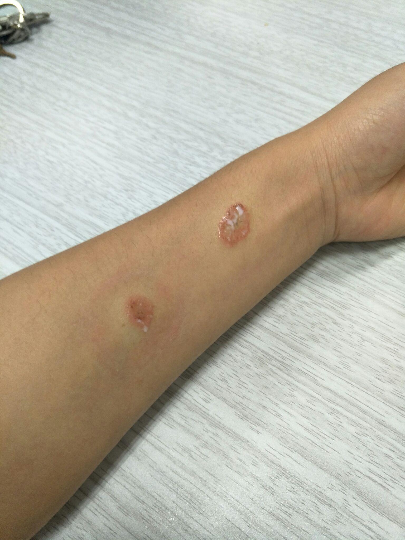 人得了猫藓怎么办