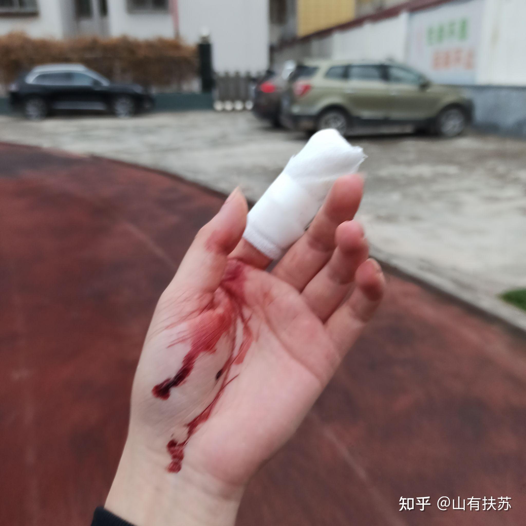 手指被切下一块肉,多长时间能恢复? - 知乎