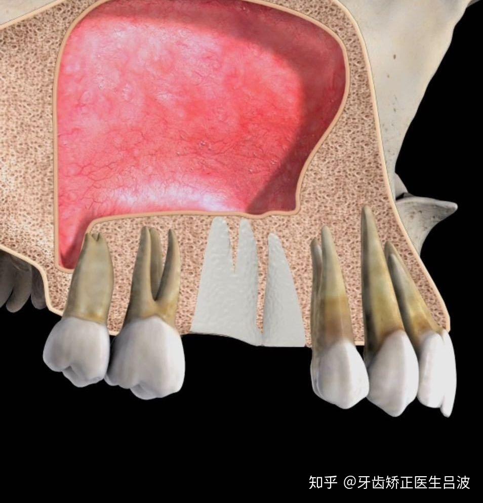 什么是上颌窦囊肿? - 知乎