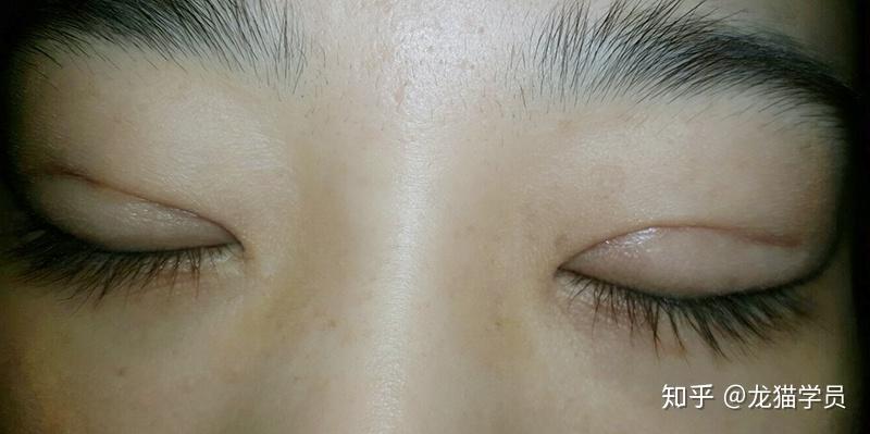 埋线双眼皮闭眼会能看到印吗? - 知乎