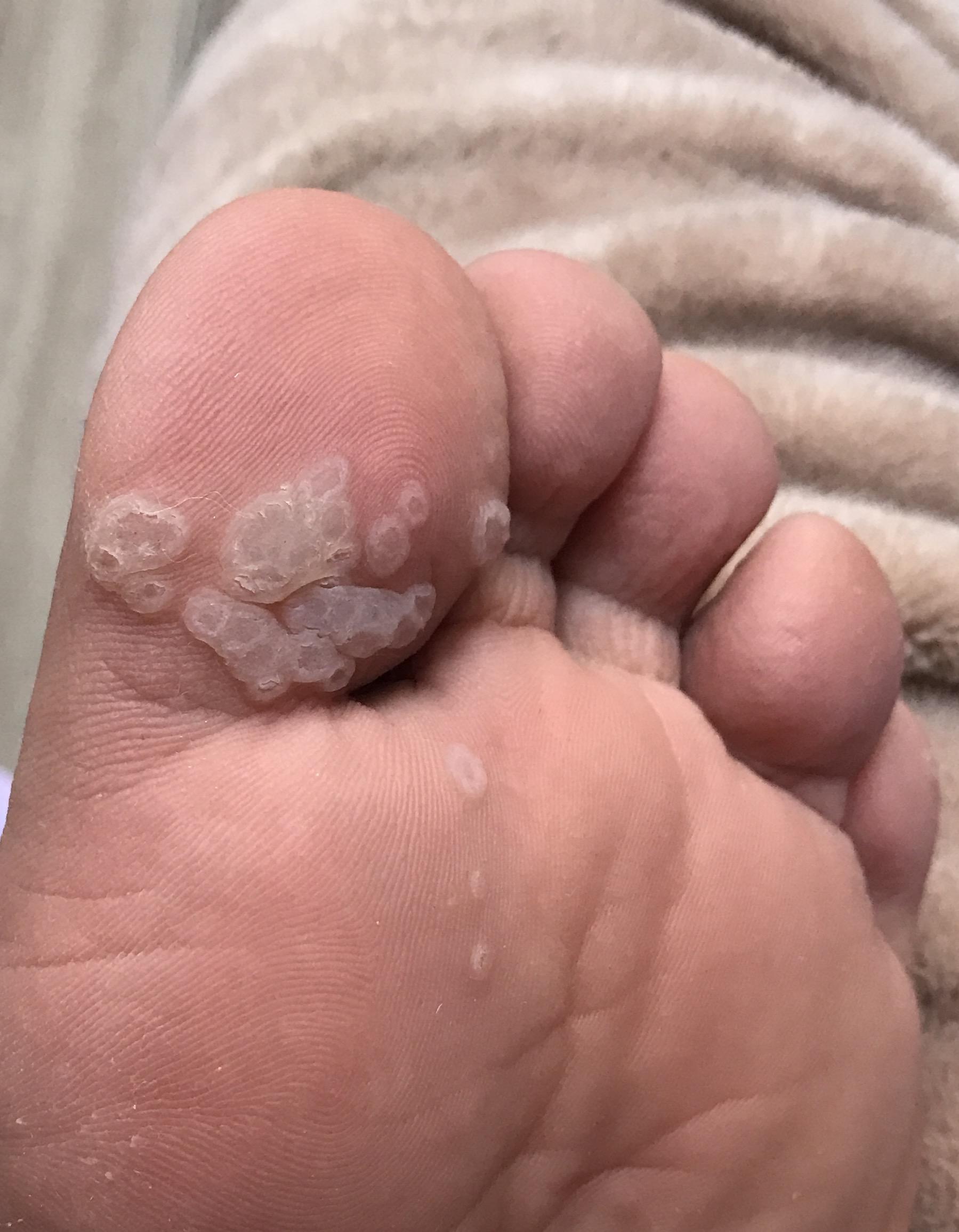 我脚上长了跖疣请问该怎么治疗?