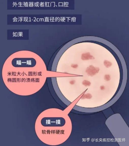 梅毒(syphilis)是什么? - 知乎