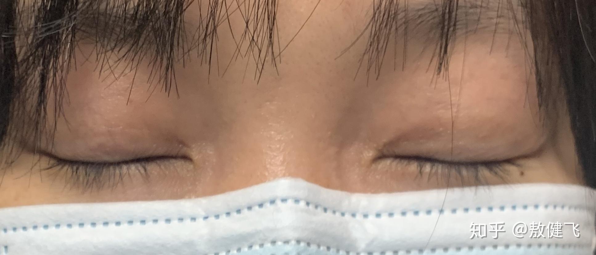 是不是所有做的双眼皮闭眼都能看见一条疤