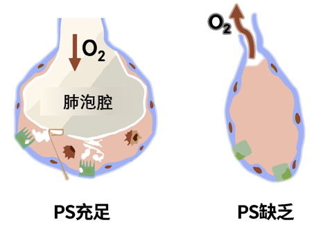 新生儿呼吸窘迫综合征