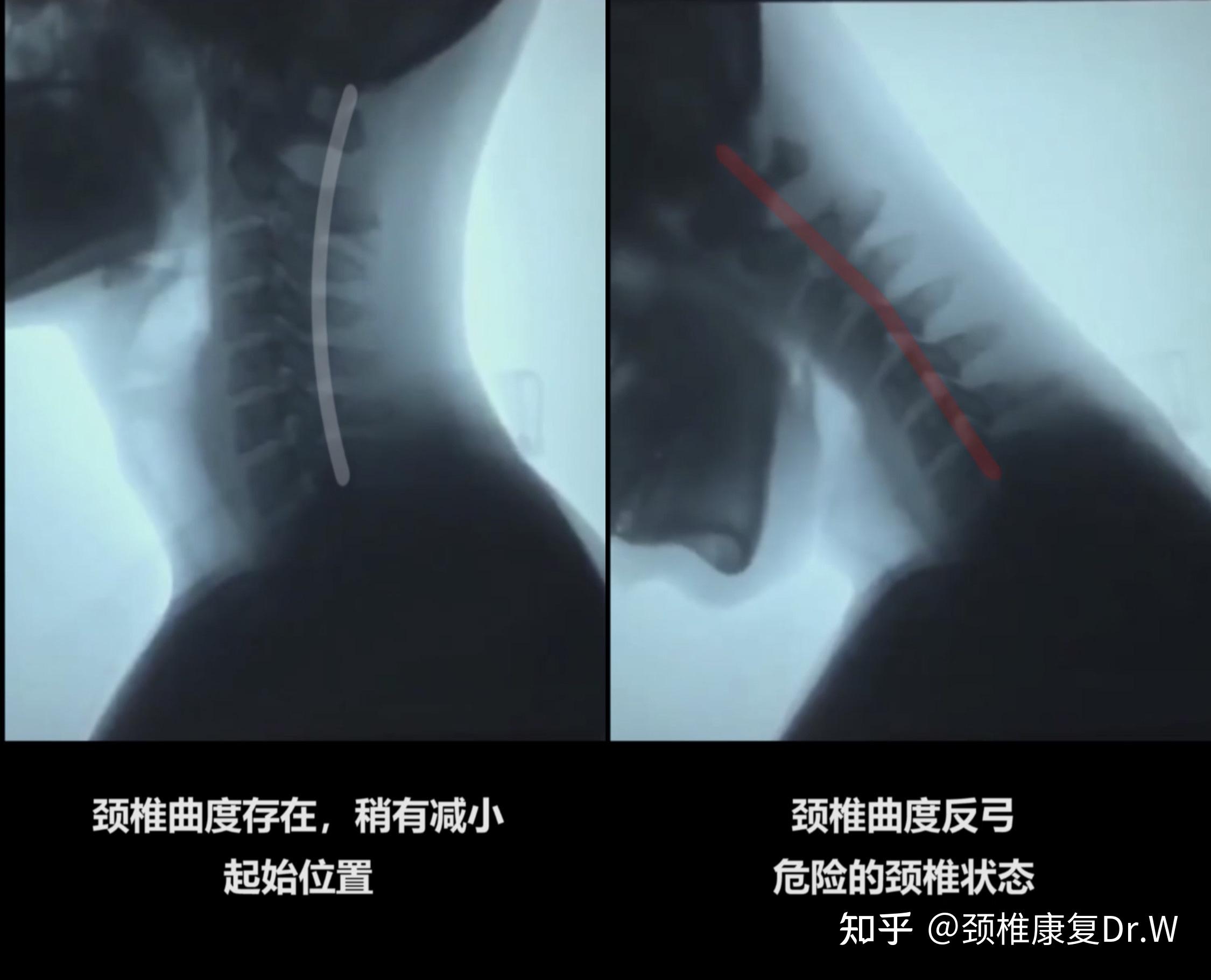 為什麼會得頸椎反弓