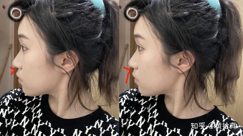 侧面看脸好丑好奇怪我这是什么情况是单纯的嘴凸吗